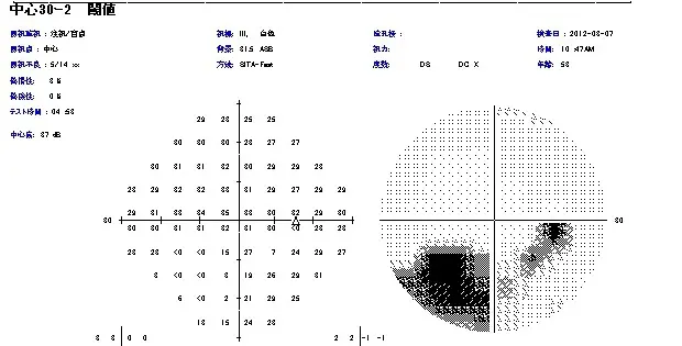 健診で視神経乳頭陥凹拡大と言われたら | イワサキ眼科医院