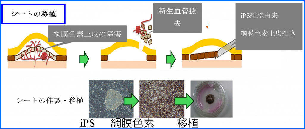 加齢黄斑変性 | イワサキ眼科医院